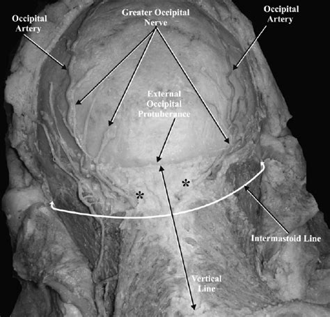 The Relationship Of The Right And Left Greater Occipital Nerves At Download Scientific