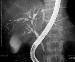 Endoscopic Retrograde Cholangiogram Showing Multiple Strictures In The