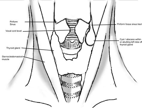 Pyriform Sinus Diagram