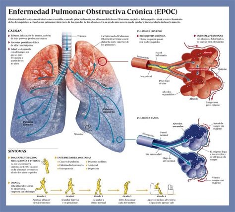 Infograf A Explicativa De La Enfermedad Pulmonar Obstructiva Cr Nica