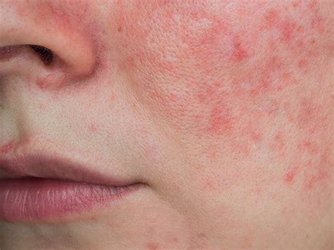 Lupus Rash Vs Rosacea Whats Causing My Butterfly Rash