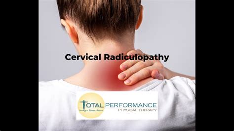 Cervical Radiculopathy Youtube