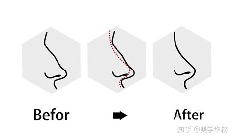 10个隆鼻9个修复？术后不要做这些！ 知乎
