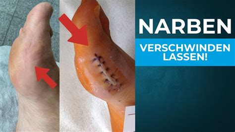 Narbenbehandlung Mit Sanotape So Kannst Du Deine Narben Quasi