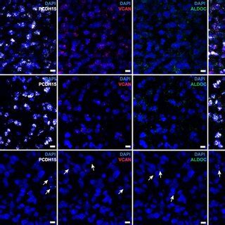 Suppressed Myelination Program In Pm Gliomas From The Cgga Dataset A