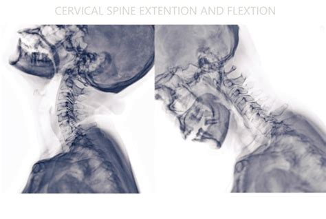 Premium Photo Xray Cspine Or Xray Image Of Cervical Spine Flexion And Extension Viewfor