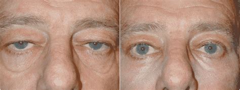 The Secret Role Festoons Play in Eyelid Rejuvenation – Adam Scheiner MD ...