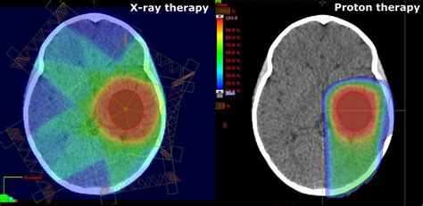 Is Proton Therapy The Silver Bullet For Children With Brain Cancer