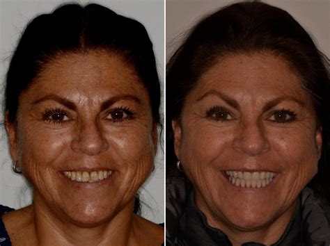 All-on-4 ® Dental Implants Photos | Miami | Patient 8863