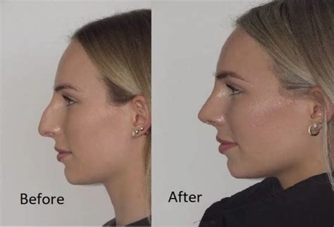 Nasal Dorsum Surgery Rhinoplasty To Correct The Nose Bridge Dr