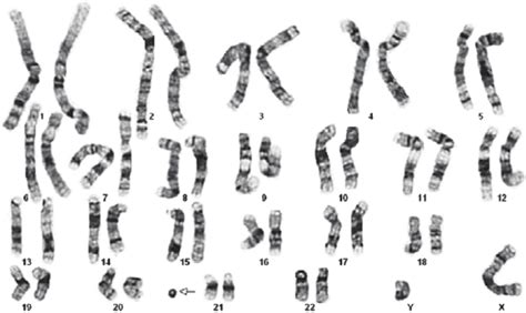 The G Banded Karyotype Of 47xyr8p1121q111 The Arrow Indicates