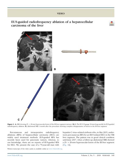 Pdf Eus Guided Radiofrequency Ablation Of A Hepatocellular Carcinoma