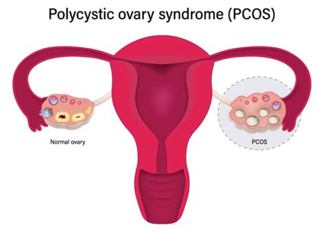 Polycystic Ovary Syndrome Pcos Patient Education Fact Sheet