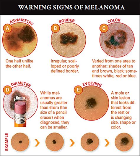 ABCDEs of Melanoma - Pariser Dermatology