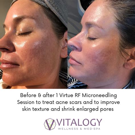 Virtue Rf Microneedling Before And After Vitalogy Wellness And Med Spa