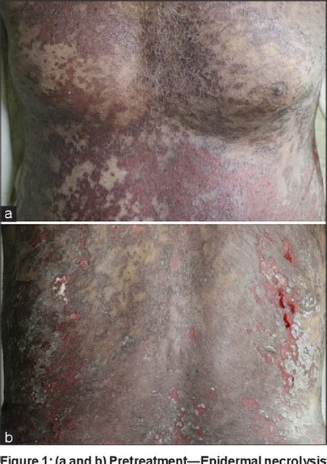 Figure 1 From Toxic Epidermal Necrolysis Like Lesions As Cutaneous