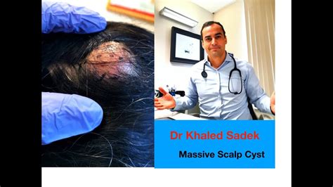 Massive Scalp Cyst LipomaCyst Dr Khaled Sadek YouTube