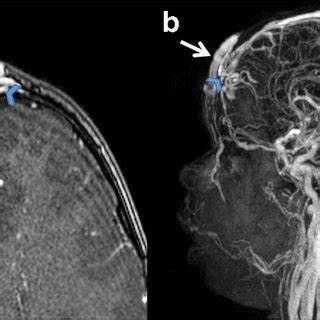 Angio MRI Axial Postcontrast SGE T1 Weighted Sequence A And Sagittal