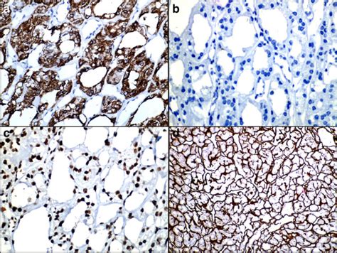 Composite Photomicrograph A Cytoplasmic And Membrane Positivity For Download Scientific