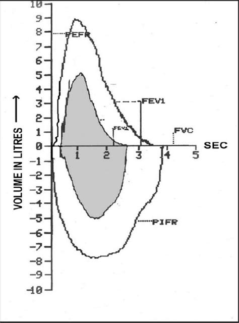 Representative Flow Volume Loop Showing Gross Derangeme Open I