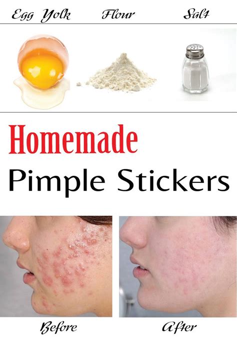 Homemade Pimple Stickers Pimples Homemade How To Treat Acne