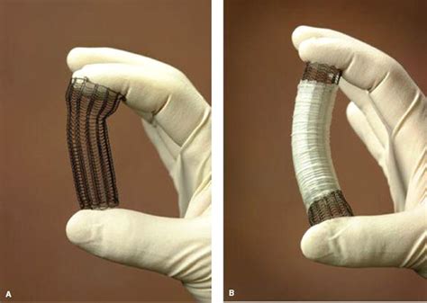 Esophageal Stents Thoracic Key