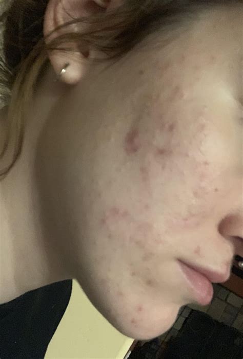 [routine Help] Just Can’t Seem To Get Rid Of These Closed Comedones Please Help R