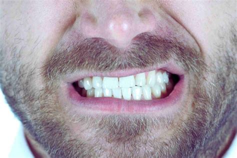 Bruxism How To Stop Grinding Teeth