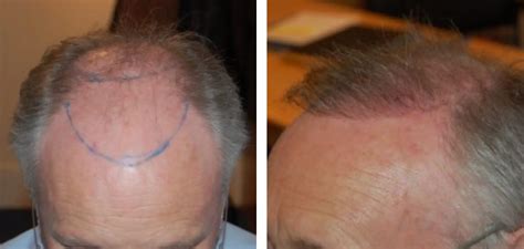 Hair Transplant After Months Photos Results Side Effects