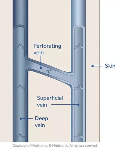 Perforator Reflux | Incompetent Perforator Veins Treatment