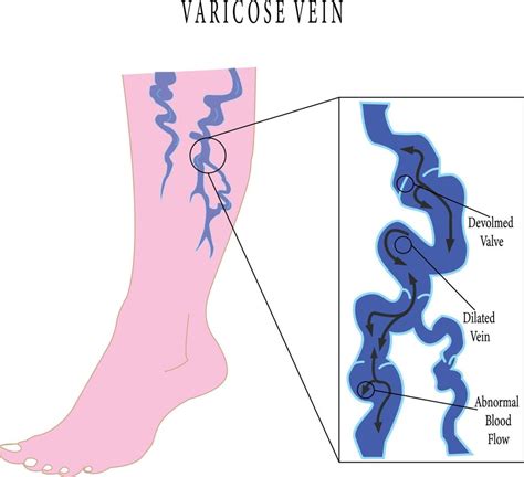 Varicose Veins Poster Vector Flat Style Cartoon Varicose Illustration