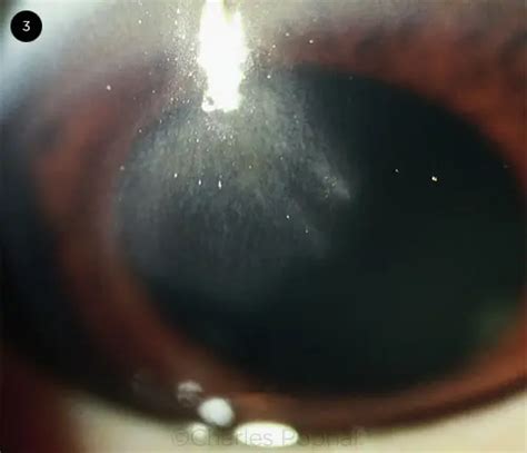 herpes zoster ophthalmicus american academy  ophthalmology