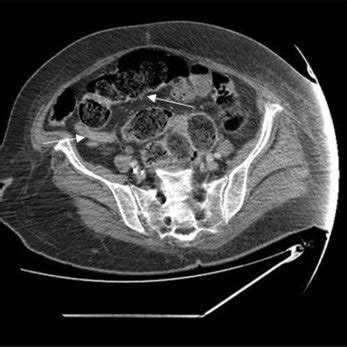 Abdominal Ct Scan Showing Fecal Impaction In Dilated Ascending And