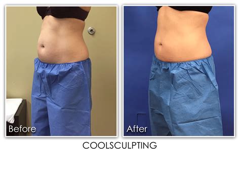 Coolsculpting Pro Archives Page 2 Of 3 Skin Rejuvenation Clinic