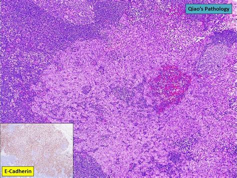 Qiao S Pathology Invasive Ductal Carcinoma With Lobular Features A