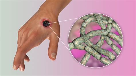 Alerta De La Oms Por Brote De Ntrax En Humanos Todo Lo Que Debes