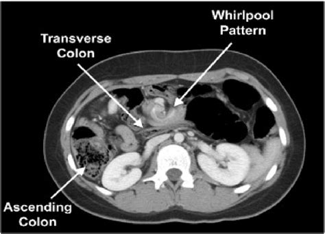 Ct Scan Of The Abdomen With Contrast Showing Intestinal Obstruction