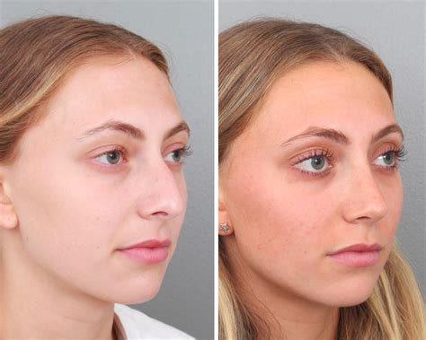 Before And After Nose Job