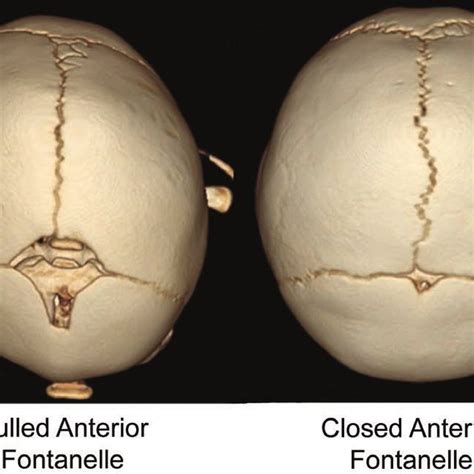 Ct Scan Findings Of Orbital Features And Metopic Suture Features In Mcs