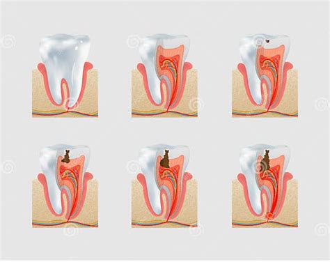 Vector El Sistema Del Icono Del Diente Sano Y De La Carie Dental Ilustración Del Vector