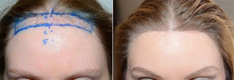 Forehead Reduction Surgery Reparative Hair Transplant Photos Miami