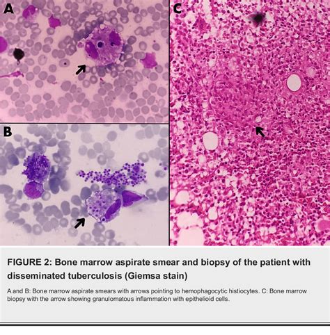 Figure 2 From Secondary Hemophagocytic Lymphohistiocytosis A Series Of