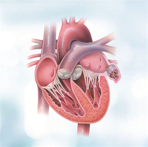 MITRA CLIP A Novel Treatment For Heart Valve Disease Introducing First