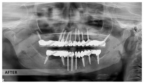 Basal Implants In Hyderabad Dr Motiwala Dental Implants Center