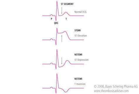 Nstemi Non St Elevation Myocardial Infarction Unstable 51 Off