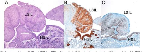 Figure 2 From Squamous Intraepithelial Lesions Of The Anal Squamocolumnar Junction