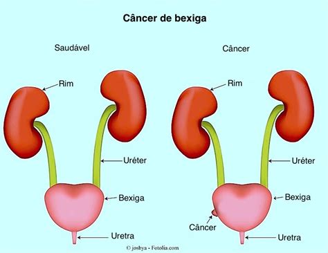 C Ncer De Bexiga Sintomas Met Stase Expectativas De Vida E Reincid Ncia