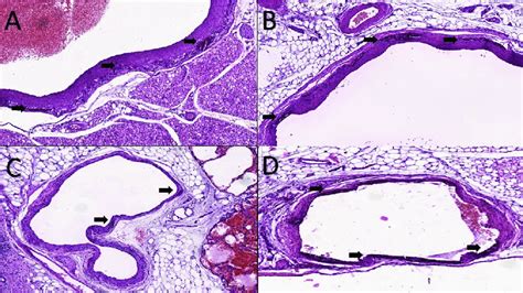 Calcification In The Veins