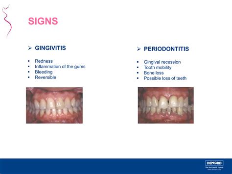 Periodontal Disease And Pregnancy Ppt