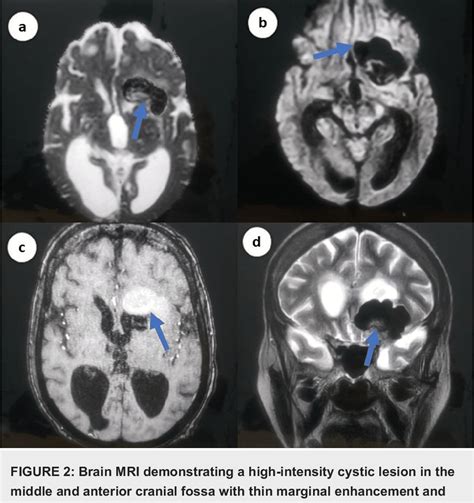 Figure 2 From An Atypical Case Of Intracranial Dermoid Cyst In An Adult